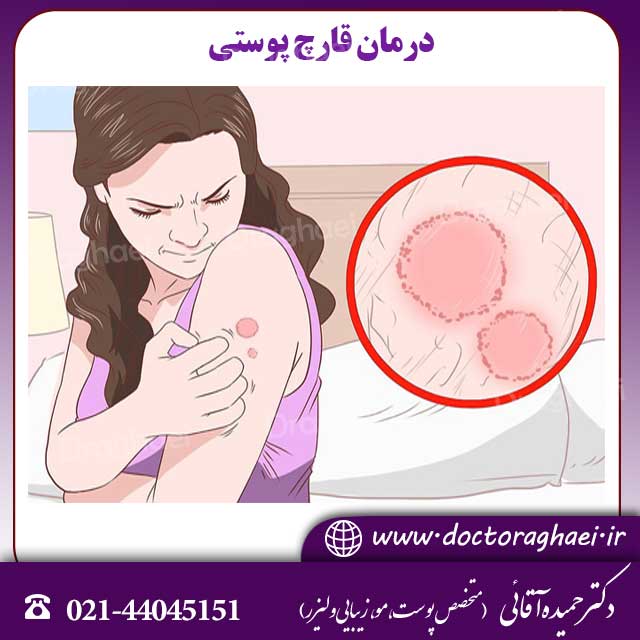 درمان قارچ پوستی