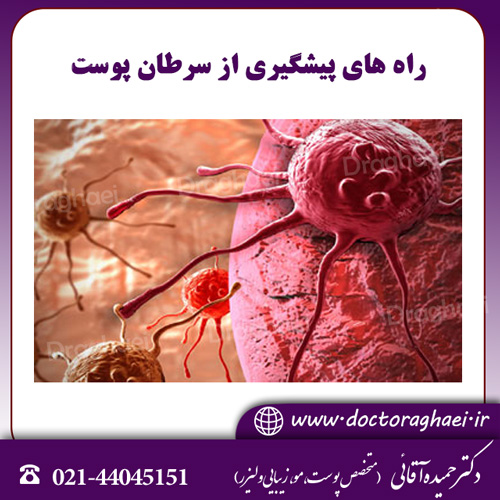 راه های پیشگیری از سرطان پوست