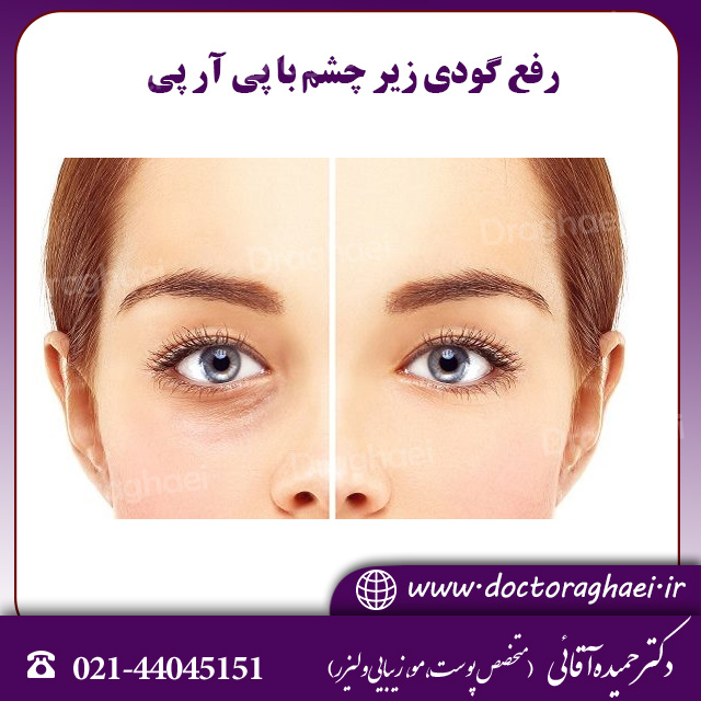رفع گودی زیر چشم با پی آر پی